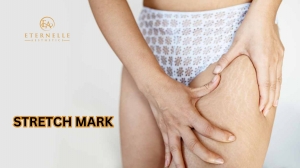 Three Most Effective Stretch Mark Removal Treatments